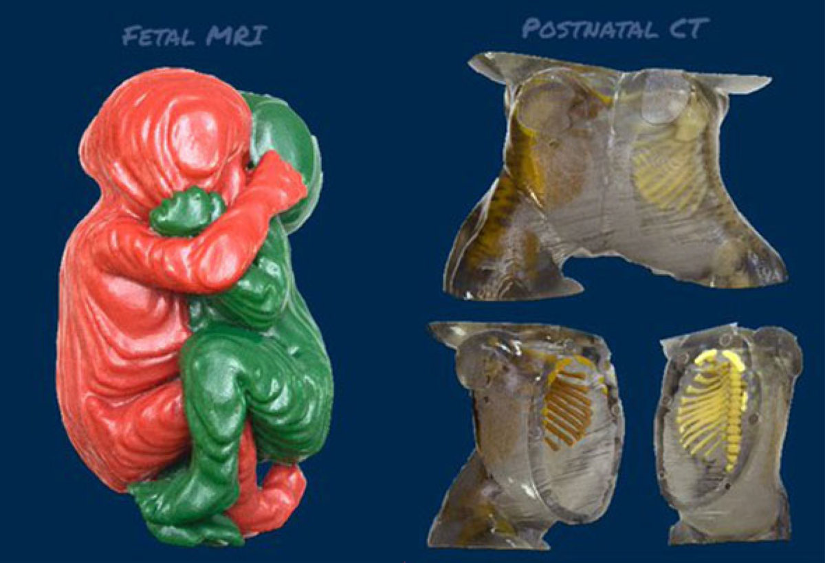 image of 3D printed models of conjoined twin used in planning the successful surgical separation of their torsos